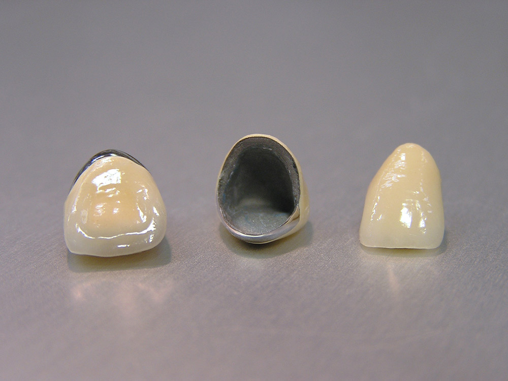 自費メタルボンドクラウン